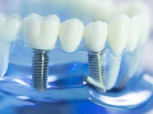 Implants For Dentures Cost